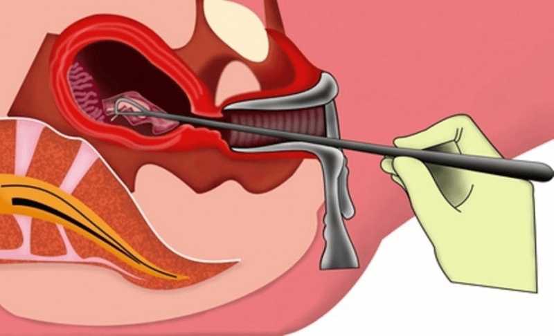 Операция выделения. Раздельное диагностическое выскабливание полости матки. Хирургический аборт выскабливание. Выскабливание слизистой оболочки матки. Выскабливание полости матки аборт.