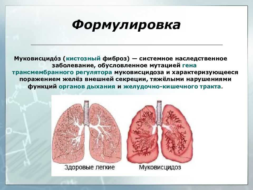 Муковисцидоз у детей