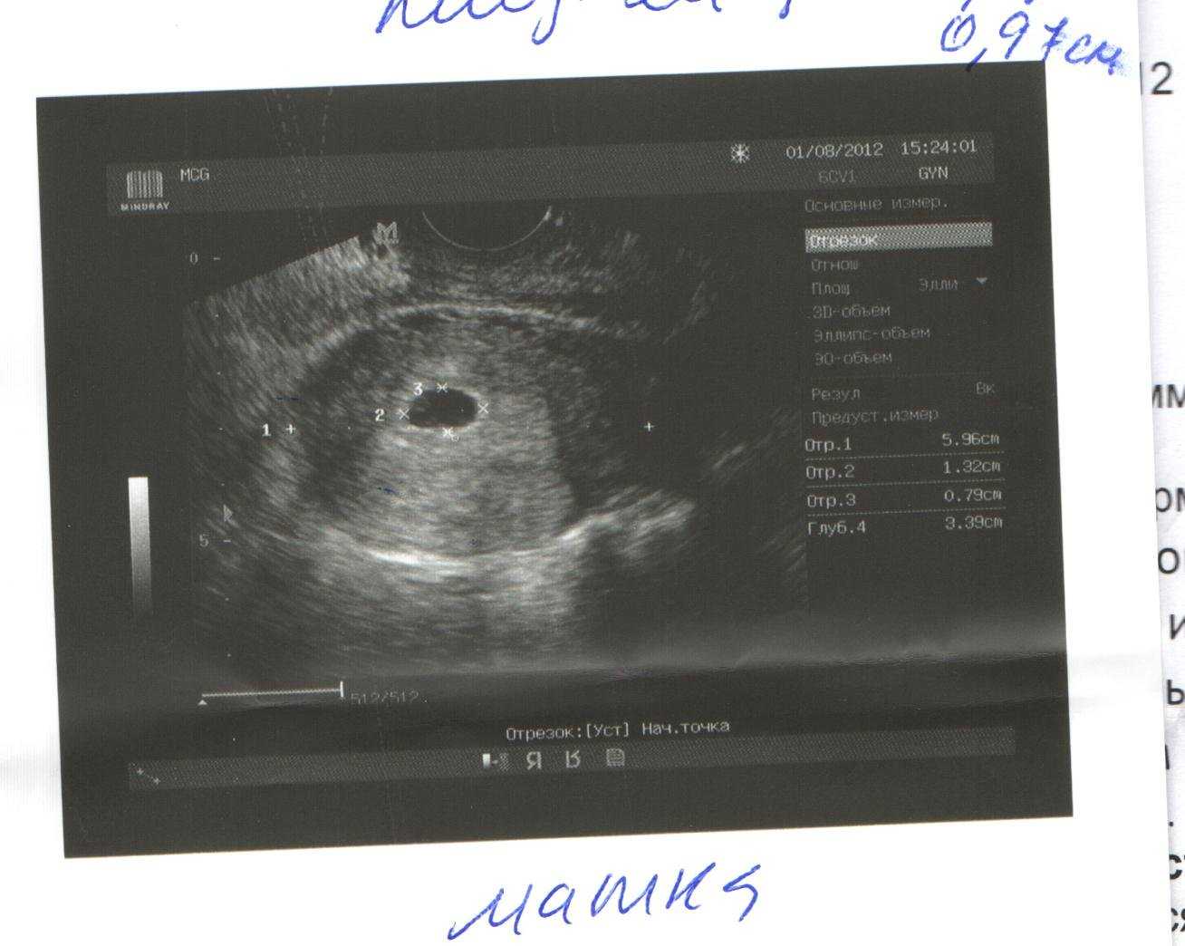 Узи на 6 акушерской неделе. Снимки УЗИ 4 недели беременности акушерская. Плодное яйцо на УЗИ 5 недель. УЗИ на 4-5 неделе беременности акушерской. УЗИ 5 акушерских недель 2 дня беременности двойня.