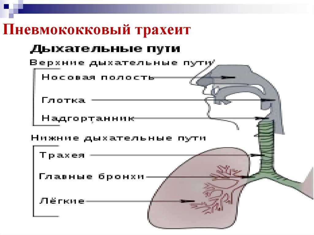 Трахеит клиническая картина