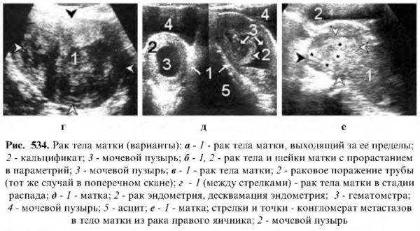 Фото после удаления матки и шейки матки