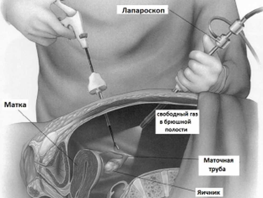 Диагностическая и оперативная лапароскопия в гинекологии