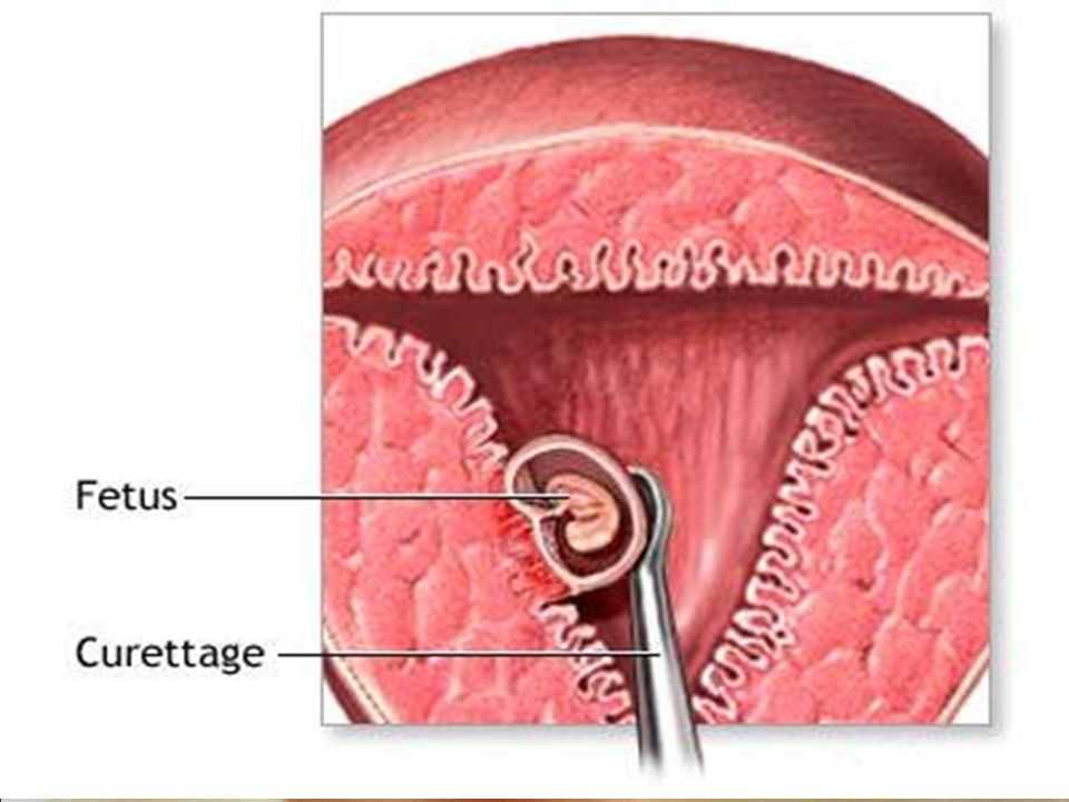 Выскабливание слизистой оболочки матки. Выскабливание плацентарной полипа. Выскабливание полости матки беременности.