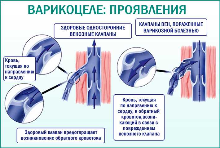 Мужское бесплодие