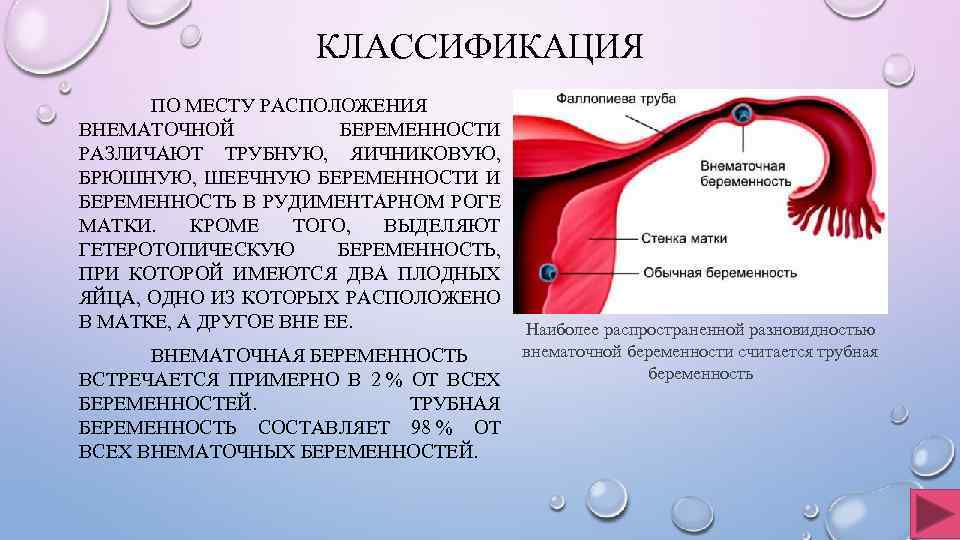 Внематочная беременность картинки женщина