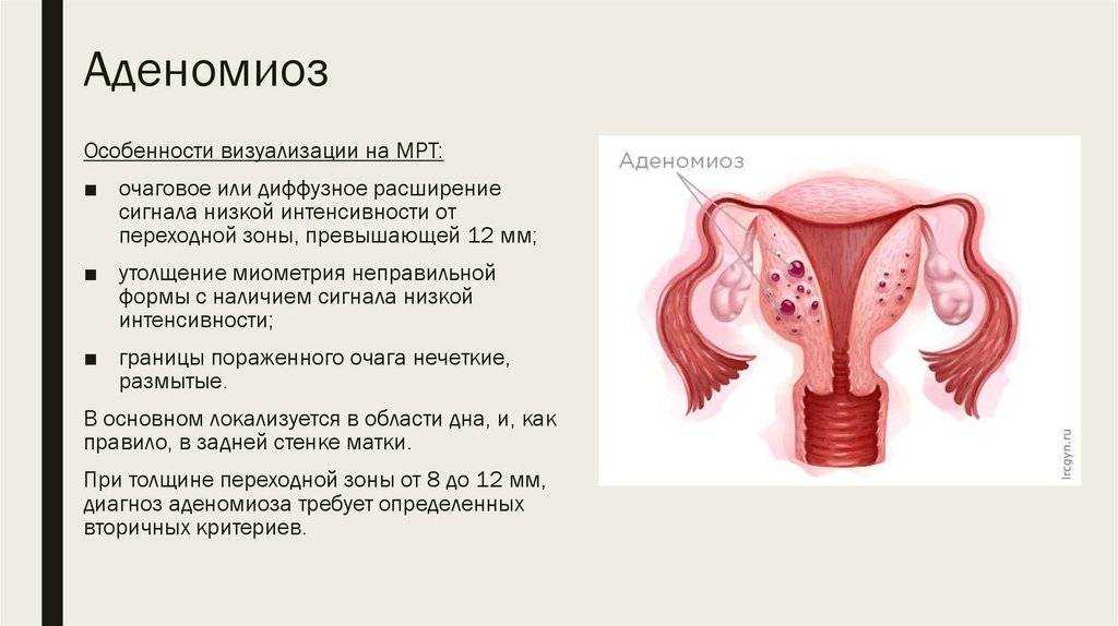 Признаки диффузной матки. Формы аденомиоза матки. Очаговый эндометриоз миометрия.