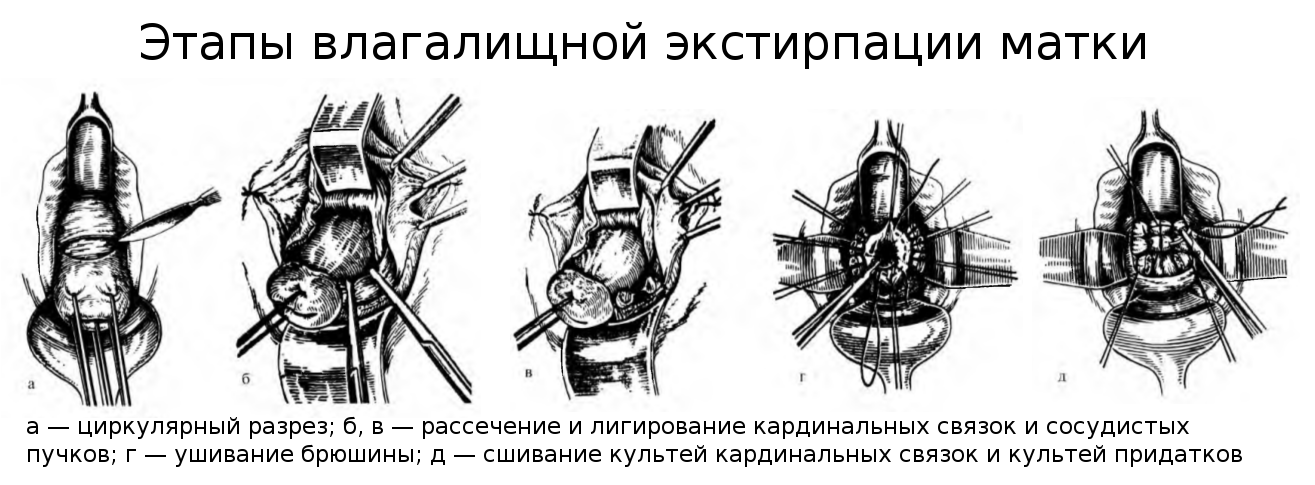 Фото после удаления матки и шейки матки