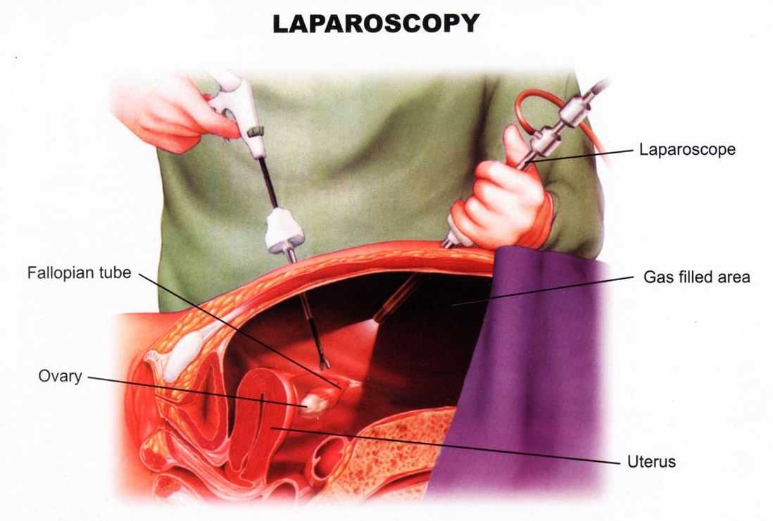 Лапароскопическая операция по восстановлению маточных труб