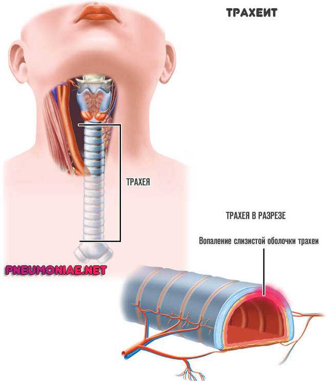 Трахеит у детей фото