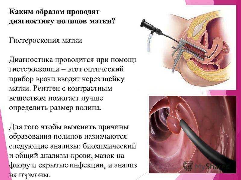 Гистероскопия матки презентация