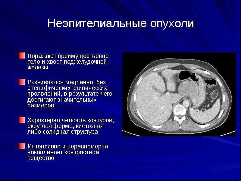 Строение опухоли картинка