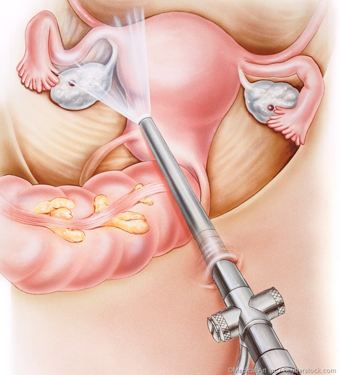 Лапароскопическая операция маточных труб является эффективной для лечения многих патологий Такая операция по восстановлению маточных труб проводится в амбулаторных условиях