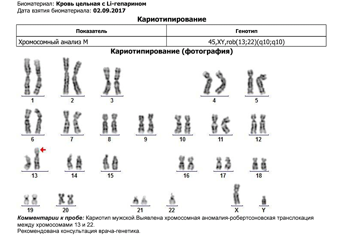 Кариотип супругов - современный способ определения совместимости