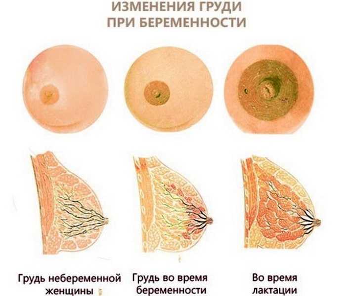 Грудь при беременности - один из важных ориентиров Она набухает и начинает болеть, готовясь к будущему кормлению Если же грудь болеть перестала - это может говорить о патологиях
