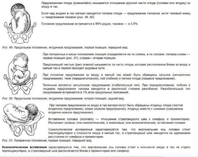 Ведение родов при тазовом предлежании
