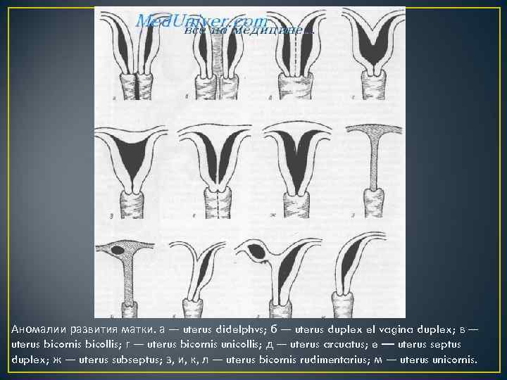 Типы маток. Аномалия развития матки (седловидная форма u2acovo по версии ESHRE. Uterus bicornis — двурогая матка,. Пороки развития матки классификация. Аномалии матки классификация.