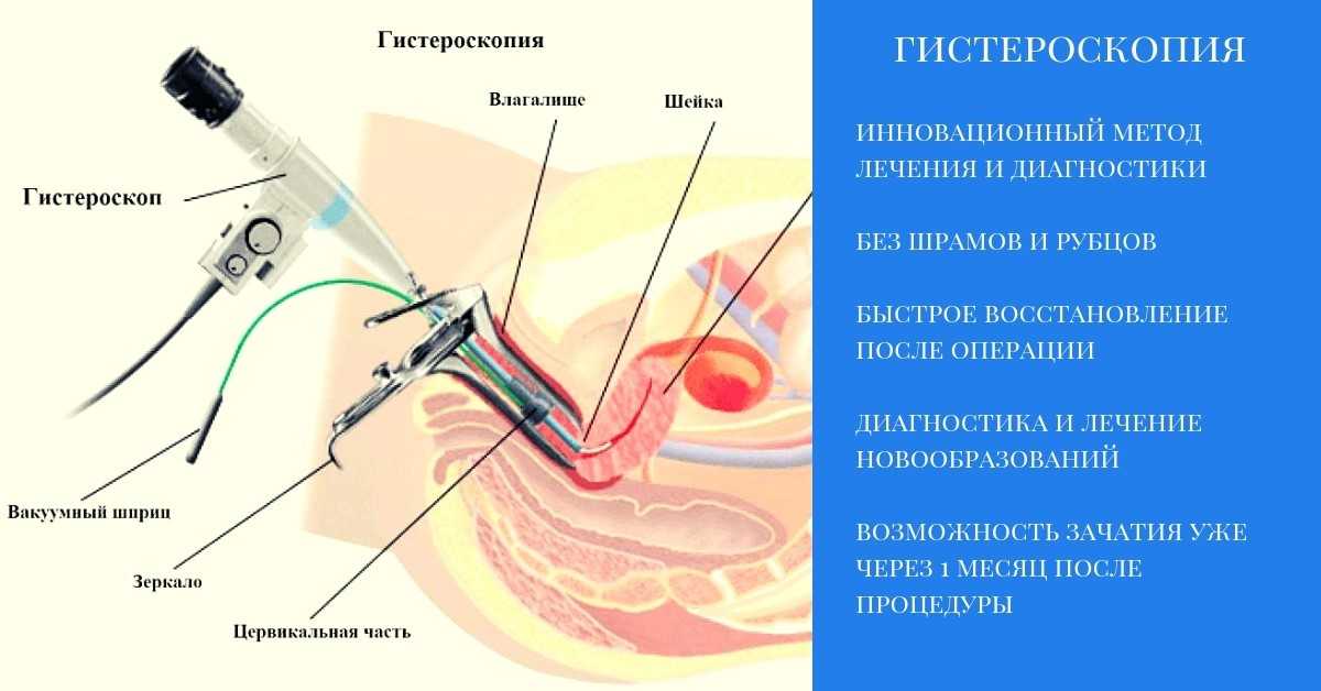 Пролиферация цилиндрического эпителия шейки матки