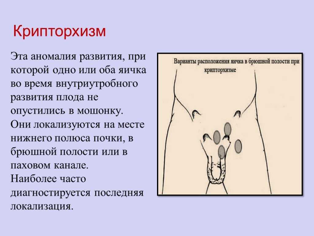 Всеобъемлющая оценка терминологии и классификации крипторхизма | сизонов | вестник урологии