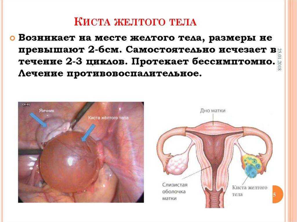 Что такое фолликулярная киста яичника